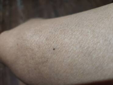 ¿Cómo los doctores detectan si un  lunar  es un cáncer? Esto es lo que dice una experta sobre cuándo preocuparse