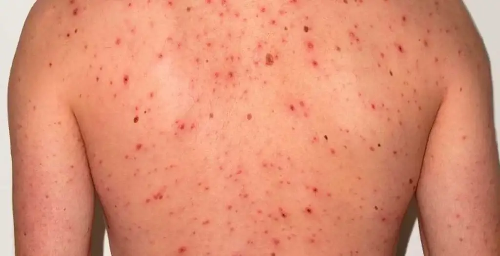 El Salvador inicia vacunación especial contra el sarampión en niños menores de un año