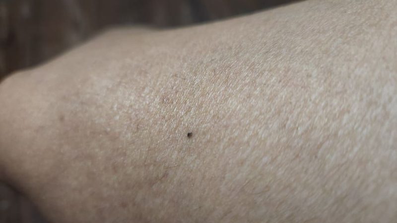 melanomas-lunares
